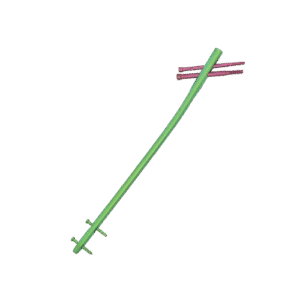 Femoral Proximal Interlocking Nail (PFN & TFN)